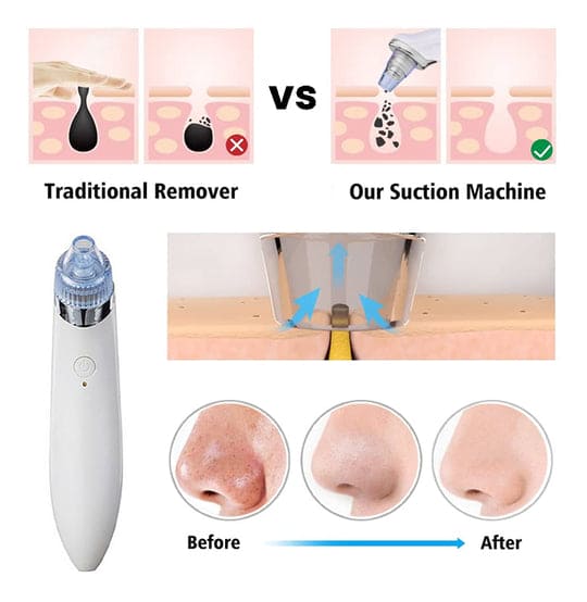 4 in 1 Blackhead Removal Machine - Qifaya