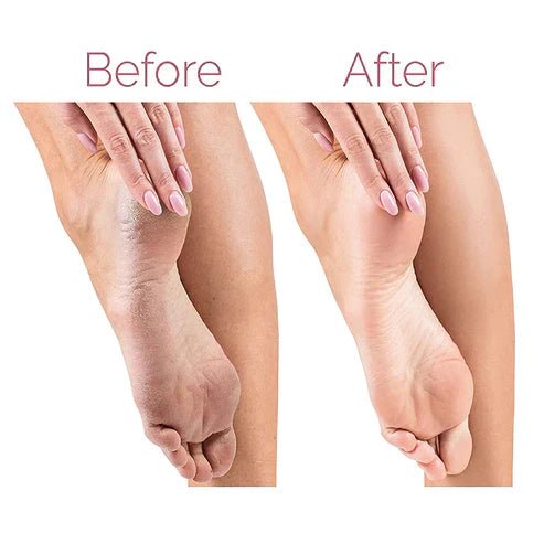 Electric Pedicure Foot File Callus Remover - Qifaya